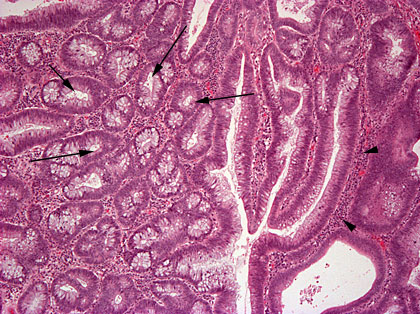 Thyroid Adenoma Treatment In Navi Mumbai